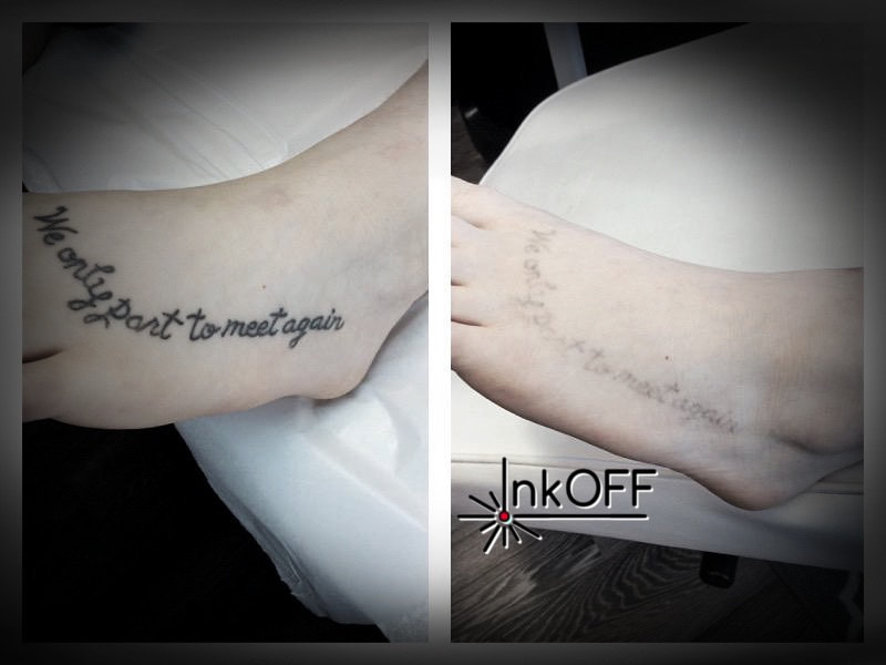 InkOFF □
Efekt laserového odstránenia tetovania 4. sedenie / 4th. treatment