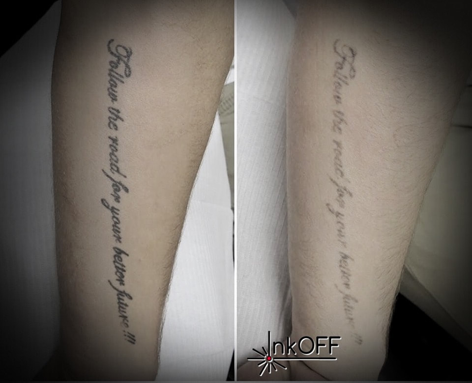 InkOFF □
Efekt laserového odstránenia tetovania 3. sedenie / 3th. treatment