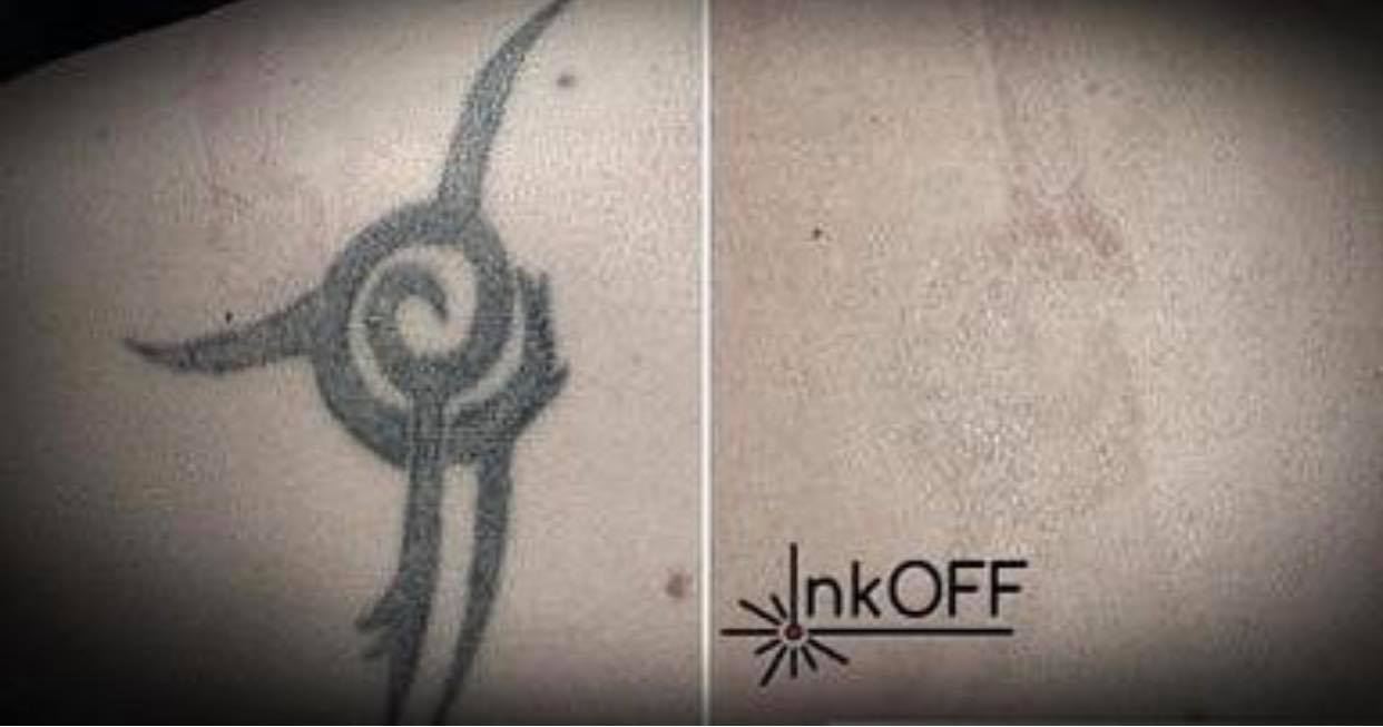 InkOFF □
Efekt laserového odstránenia tetovania 5. sedenie / 5th. treatment
