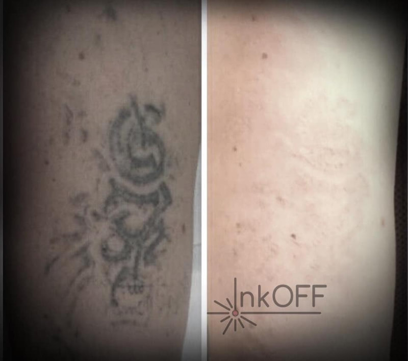 InkOFF □
Efekt laserového odstránenia tetovania 4. sedenie / 4th. treatment
