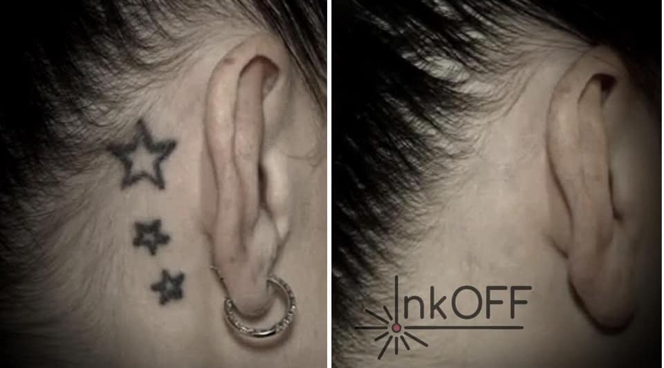 InkOFF □
Efekt laserového odstránenia tetovania 5. sedenie / 5th. treatment